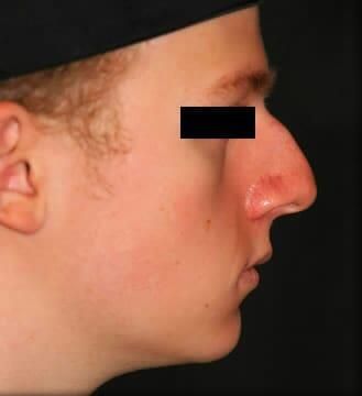 Rhinoplasty Before & After