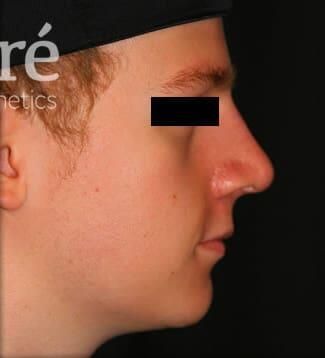 Rhinoplasty Before & After