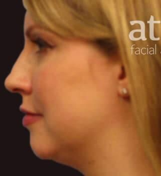 Rhinoplasty Before & After