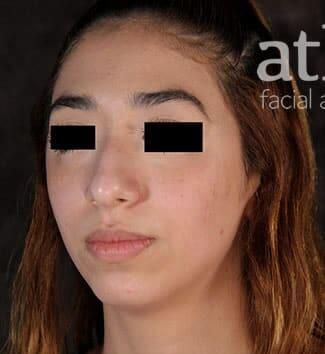Rhinoplasty Before & After