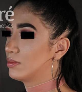 Rhinoplasty Before & After