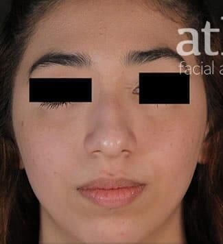 Rhinoplasty Before & After