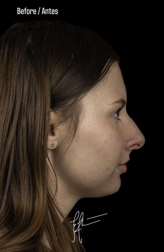 Rhinoplasty Before & After