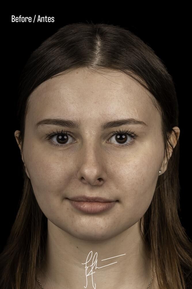 Rhinoplasty Before & After