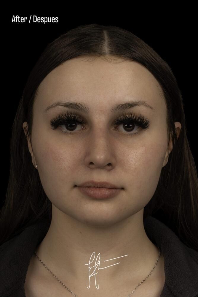 Rhinoplasty Before & After