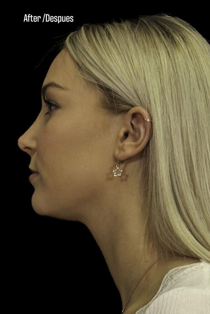 Rhinoplasty Before & After