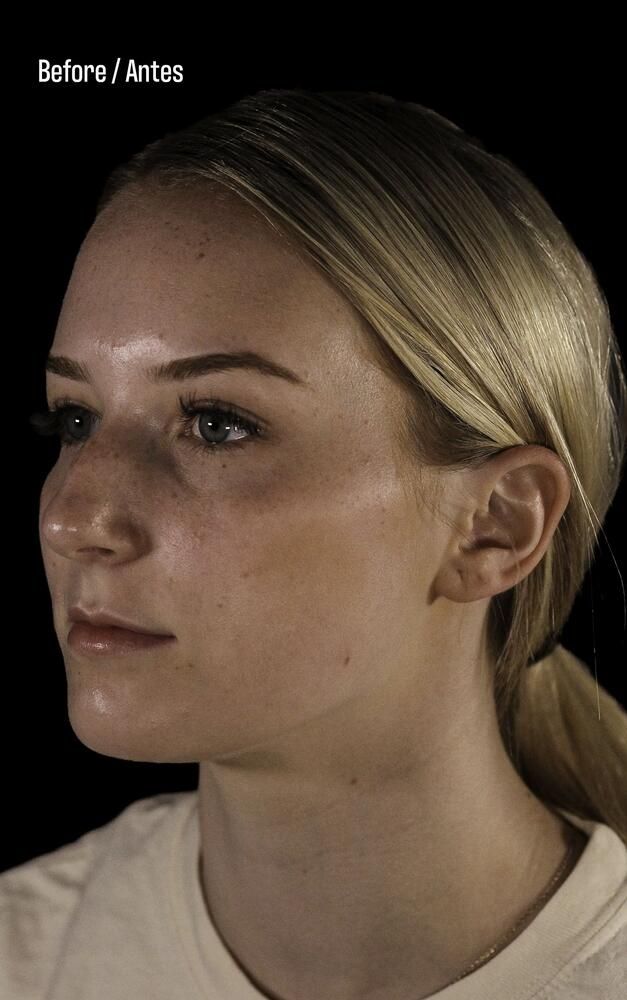 Rhinoplasty Before & After