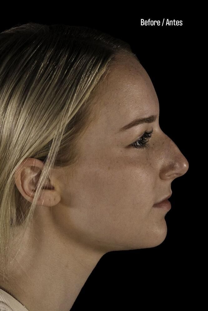 Rhinoplasty Before & After