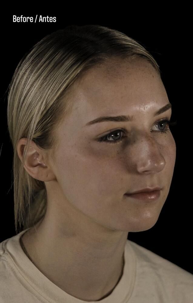 Rhinoplasty Before & After