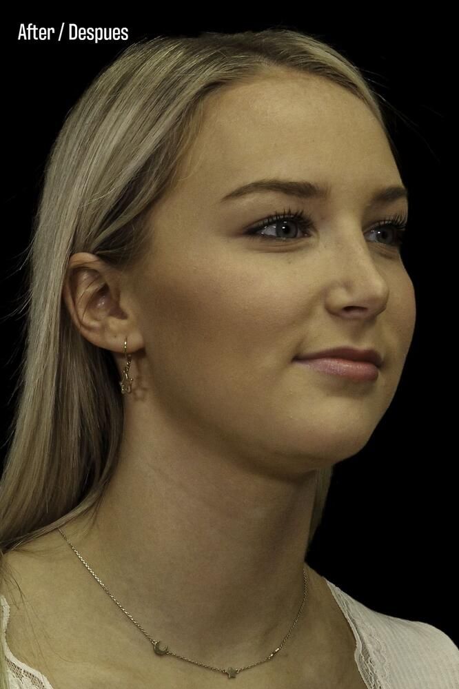 Rhinoplasty Before & After