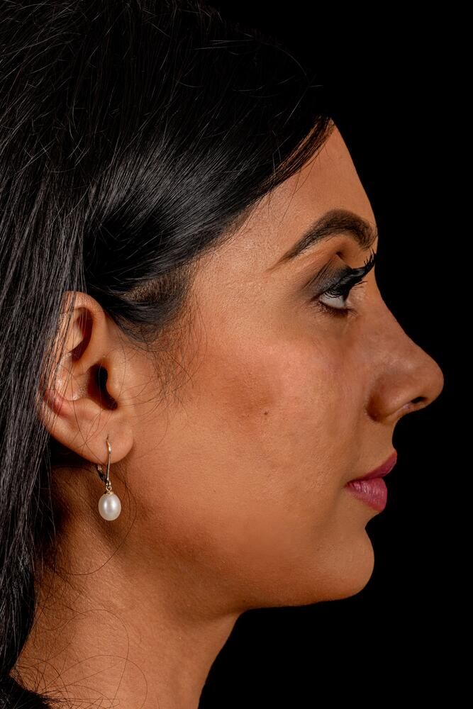 Rhinoplasty Before & After