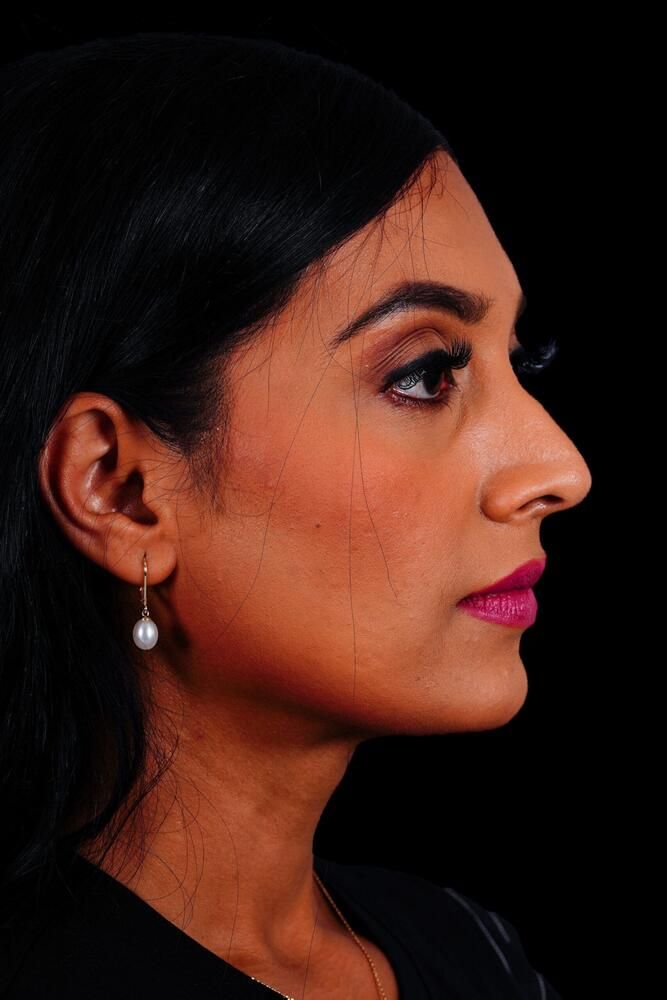 Rhinoplasty Before & After