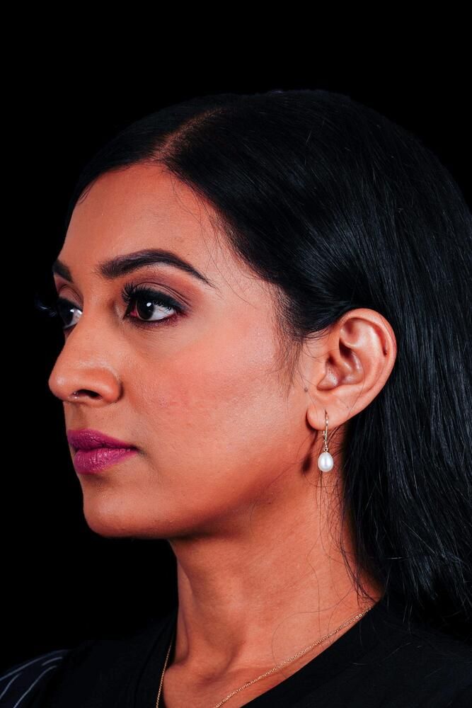 Rhinoplasty Before & After