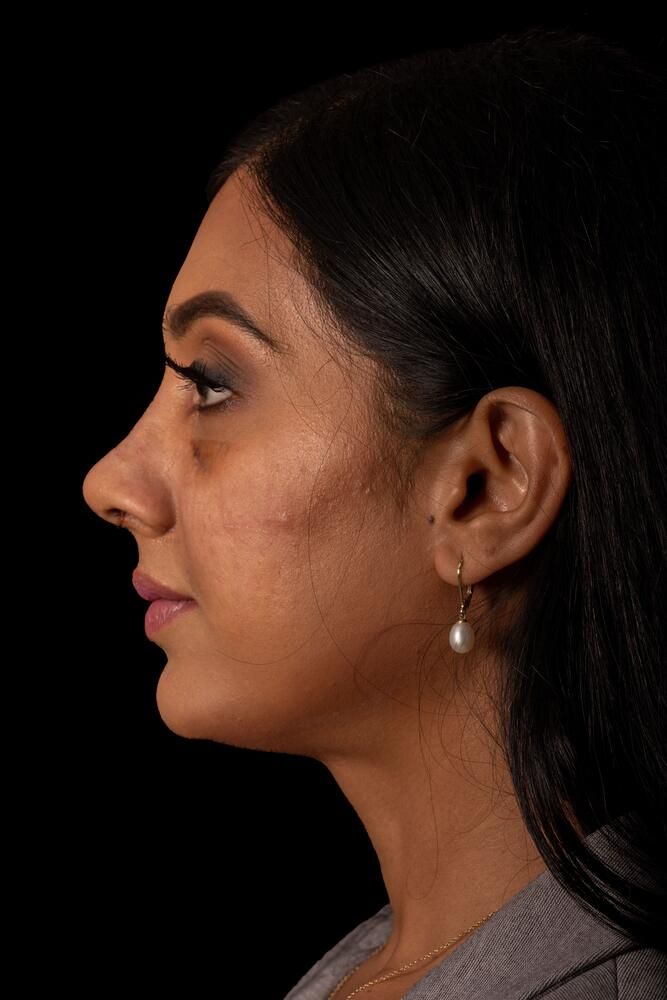 Rhinoplasty Before & After