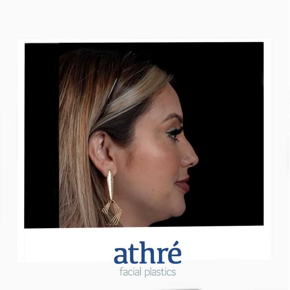 Rhinoplasty Before & After