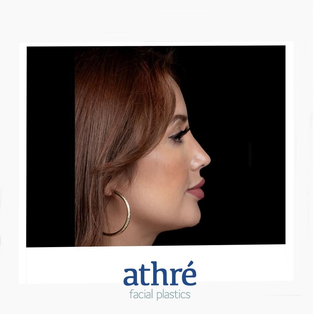Rhinoplasty Before & After