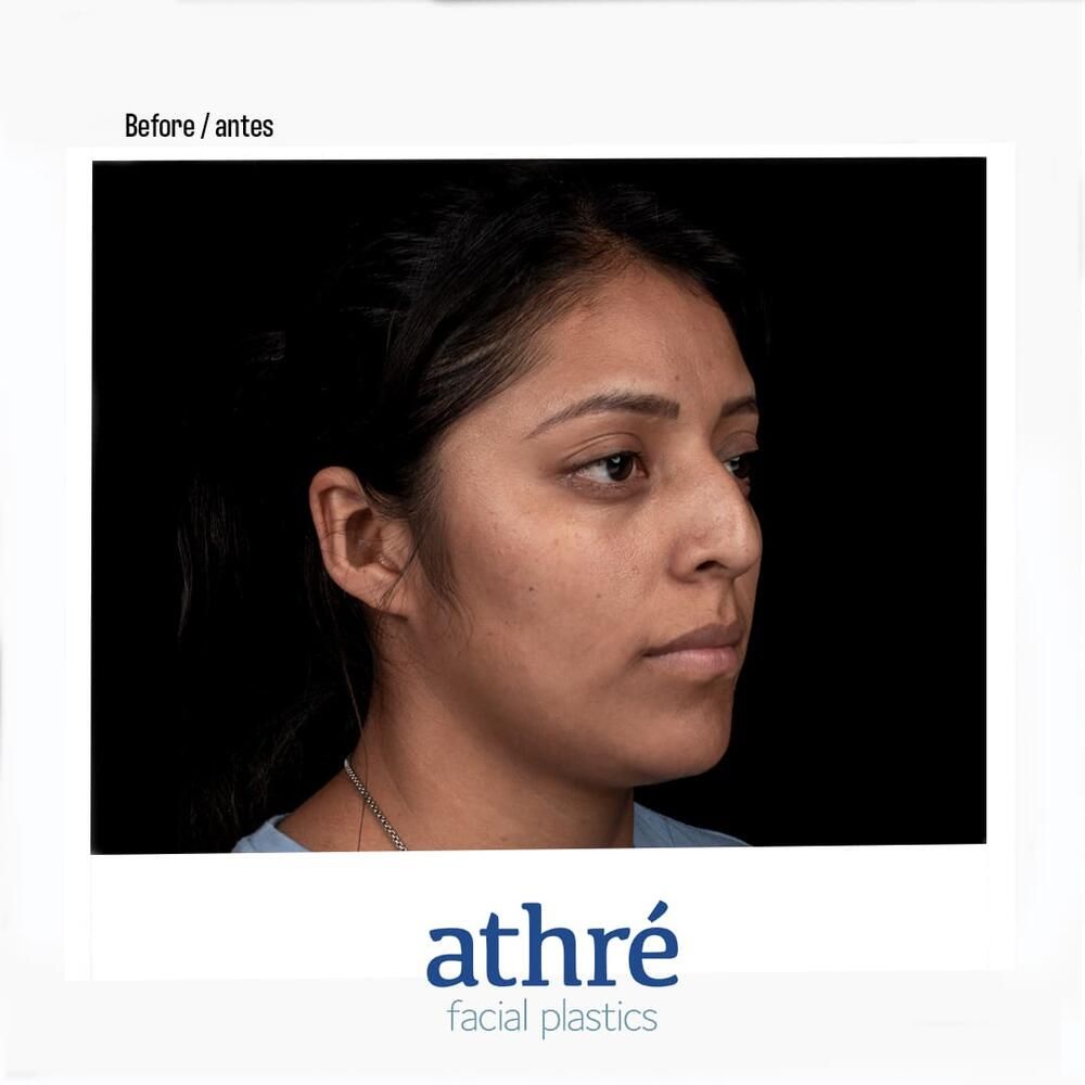 Rhinoplasty Before & After