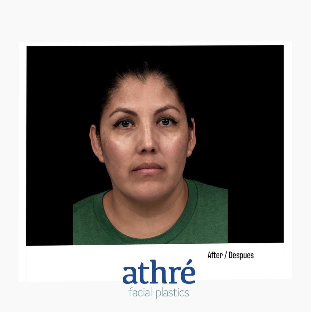 Rhinoplasty Before & After