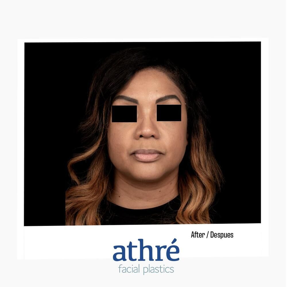 Rhinoplasty Before & After