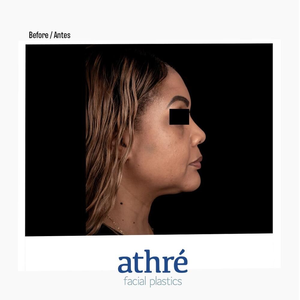 Rhinoplasty Before & After