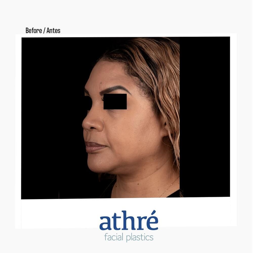 Rhinoplasty Before & After