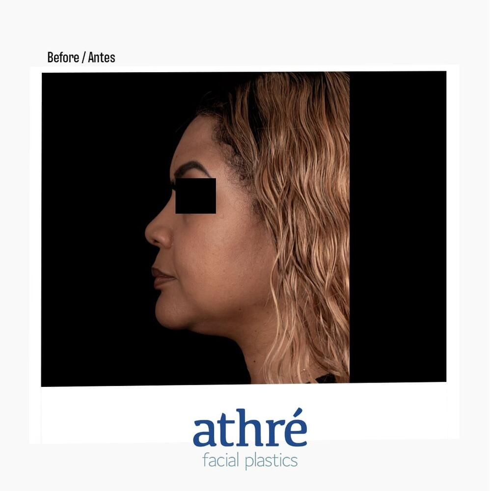 Rhinoplasty Before & After