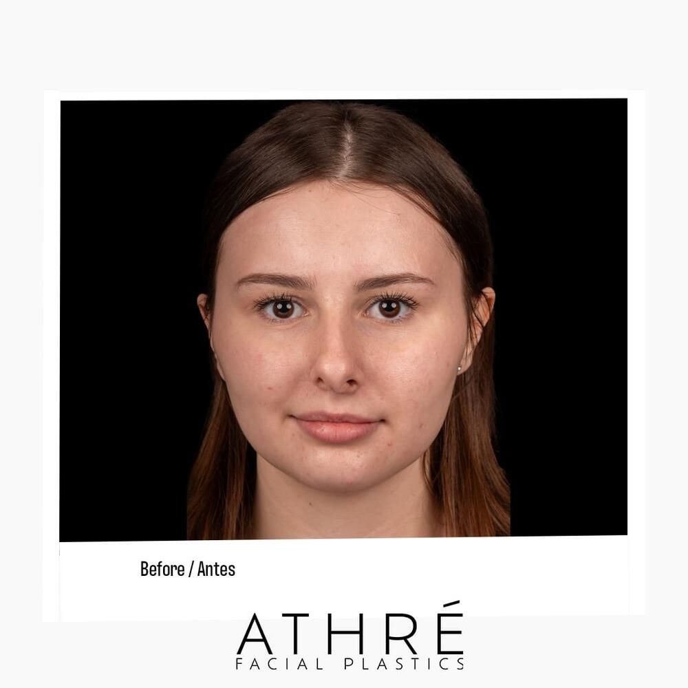 Rhinoplasty Before & After