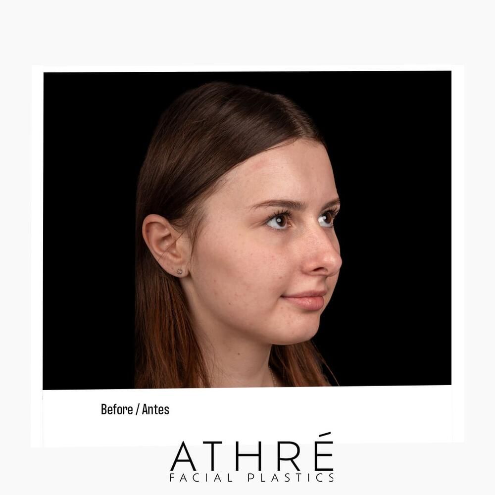 Rhinoplasty Before & After