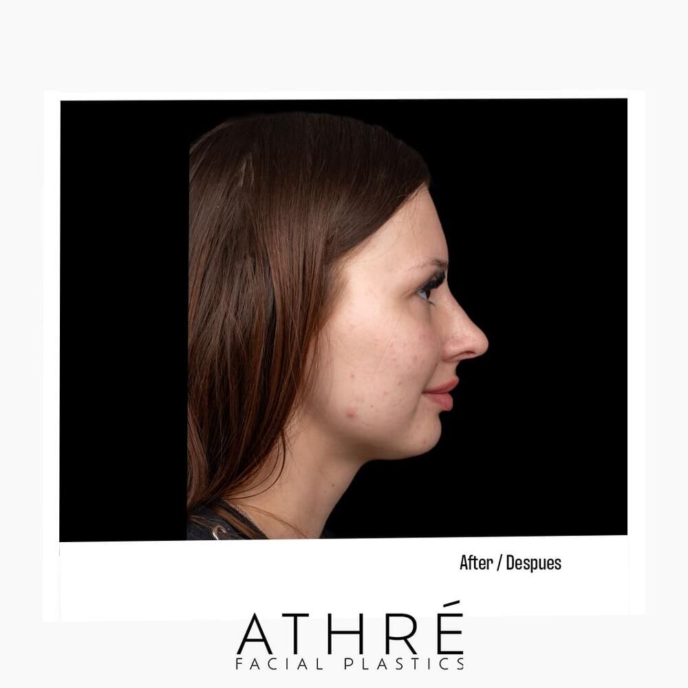 Rhinoplasty Before & After