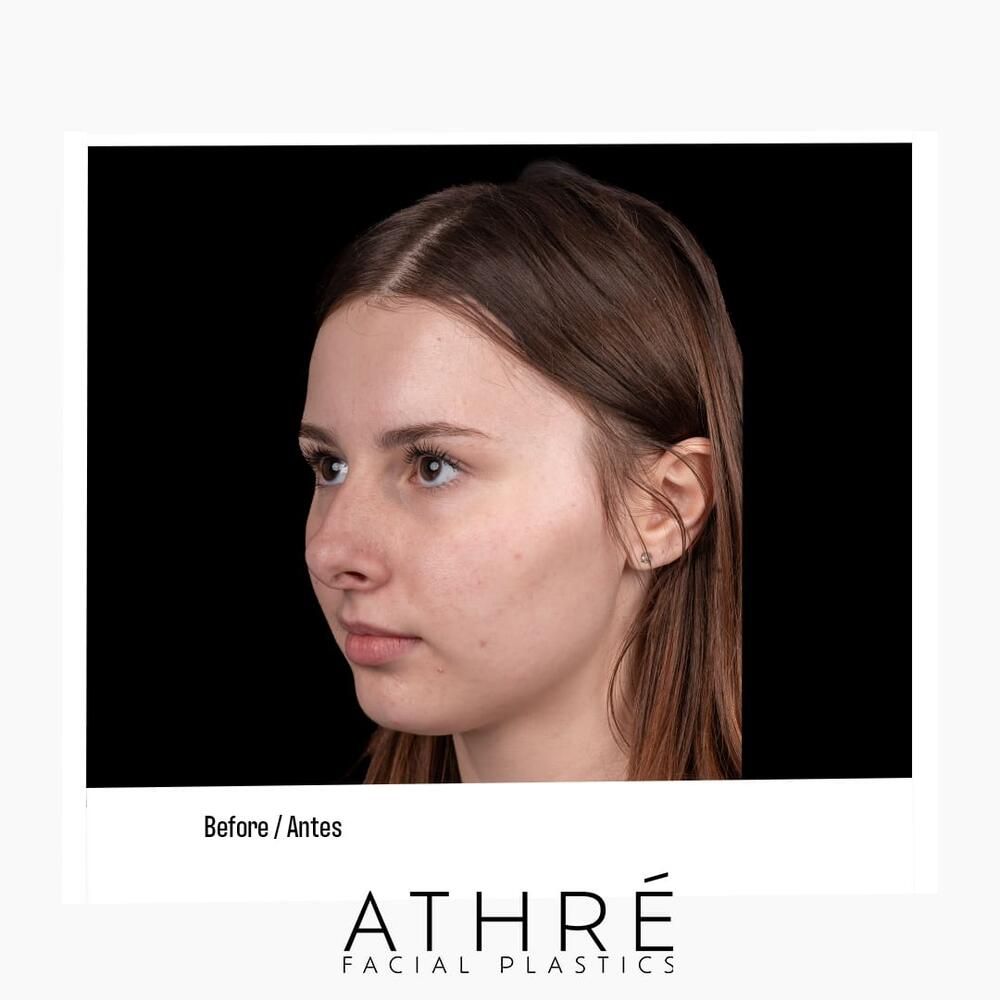 Rhinoplasty Before & After