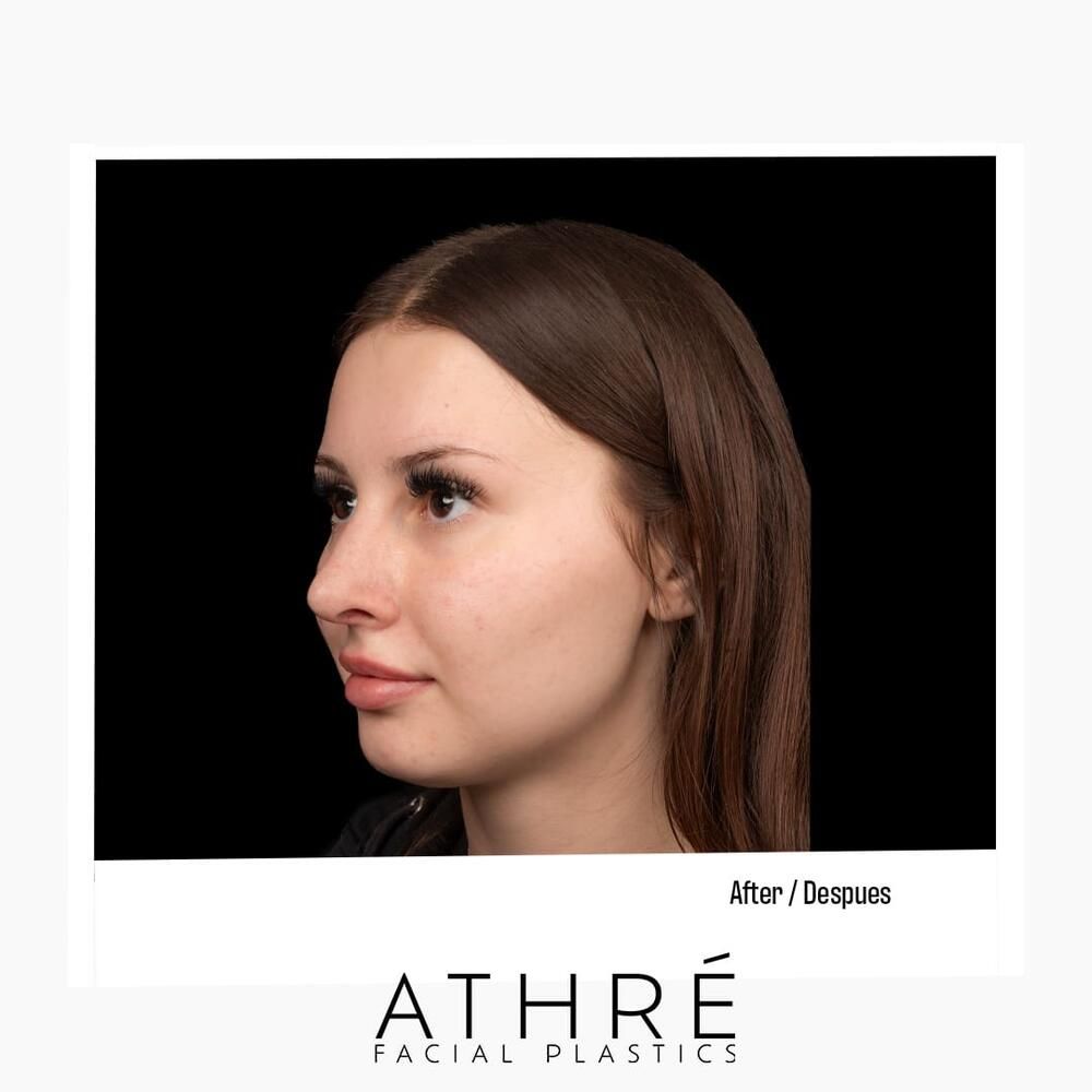 Rhinoplasty Before & After