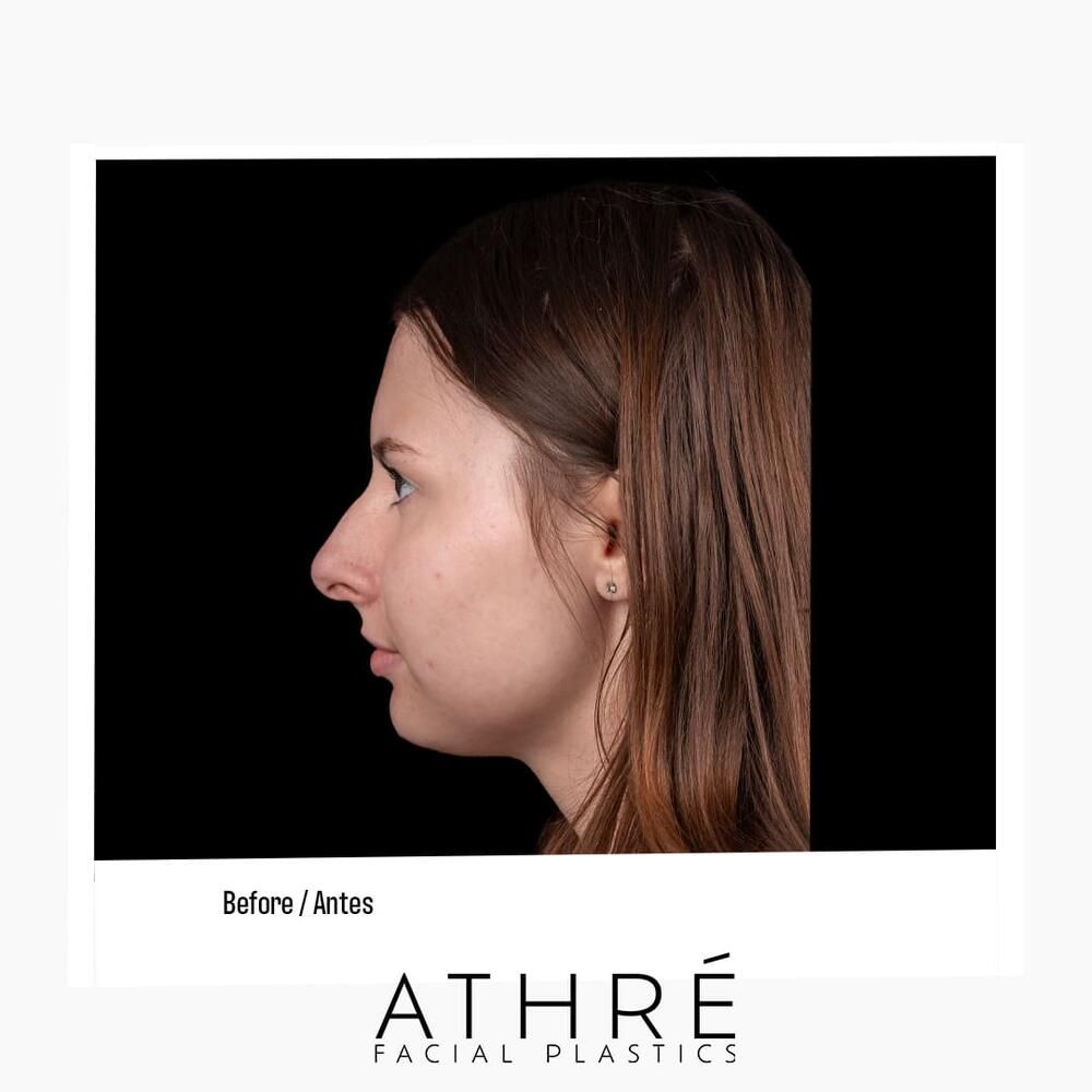 Rhinoplasty Before & After