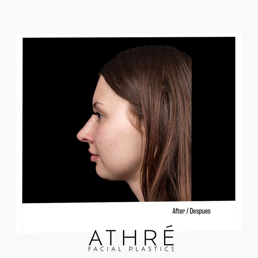 Rhinoplasty Before & After