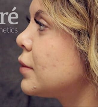 Revision Rhinoplasty Before & After