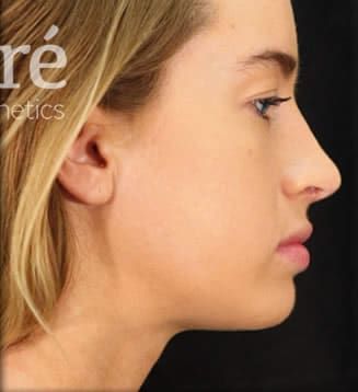 Revision Rhinoplasty Before & After