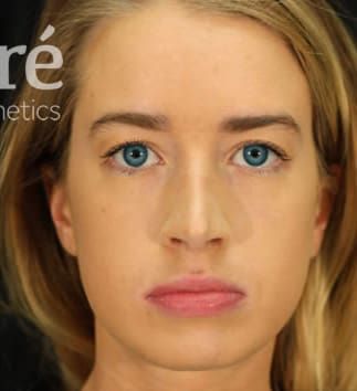 Revision Rhinoplasty Before & After