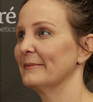 Revision Rhinoplasty Before & After