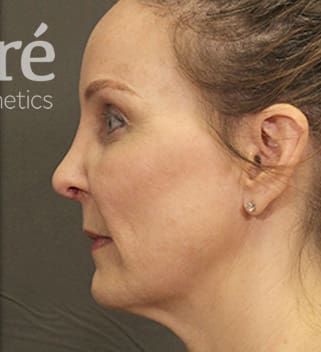 Revision Rhinoplasty Before & After