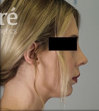 Revision Rhinoplasty Before & After