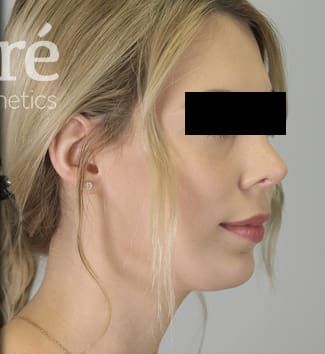 Revision Rhinoplasty Before & After