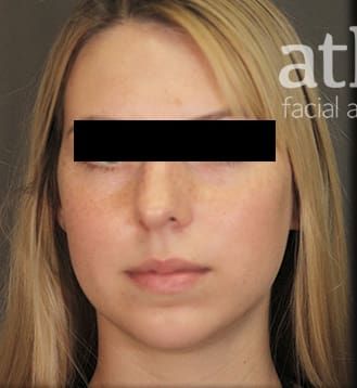 Revision Rhinoplasty Before & After