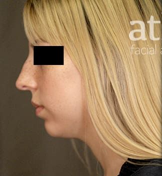 Revision Rhinoplasty Before & After