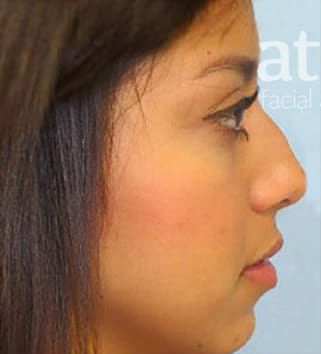 Revision Rhinoplasty Before & After
