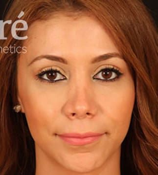 Revision Rhinoplasty Before & After