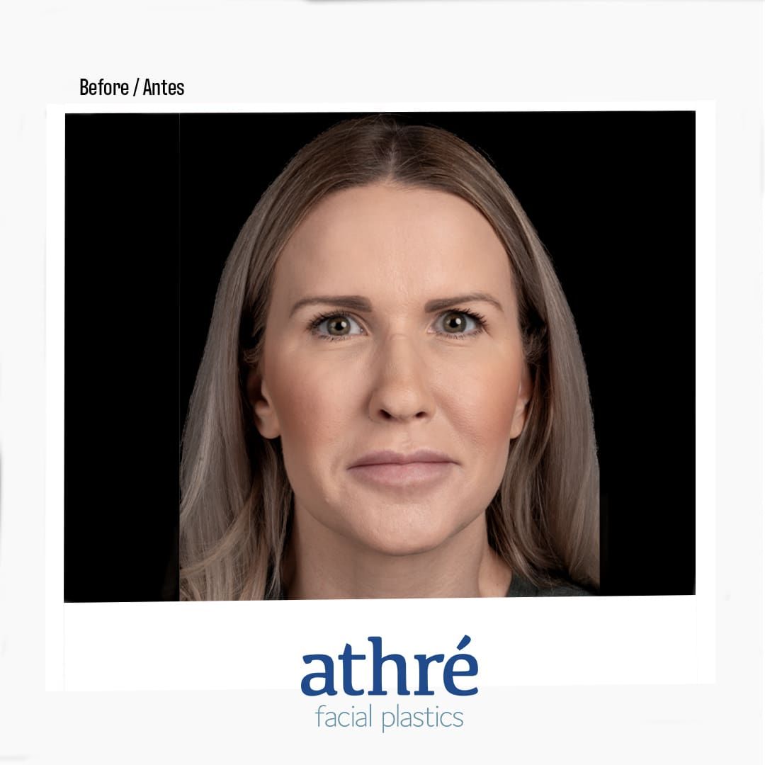 Revision Rhinoplasty Before & After