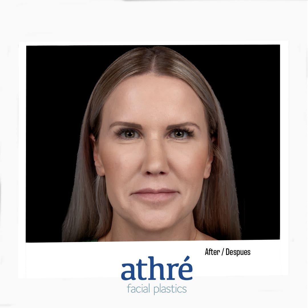 Revision Rhinoplasty Before & After