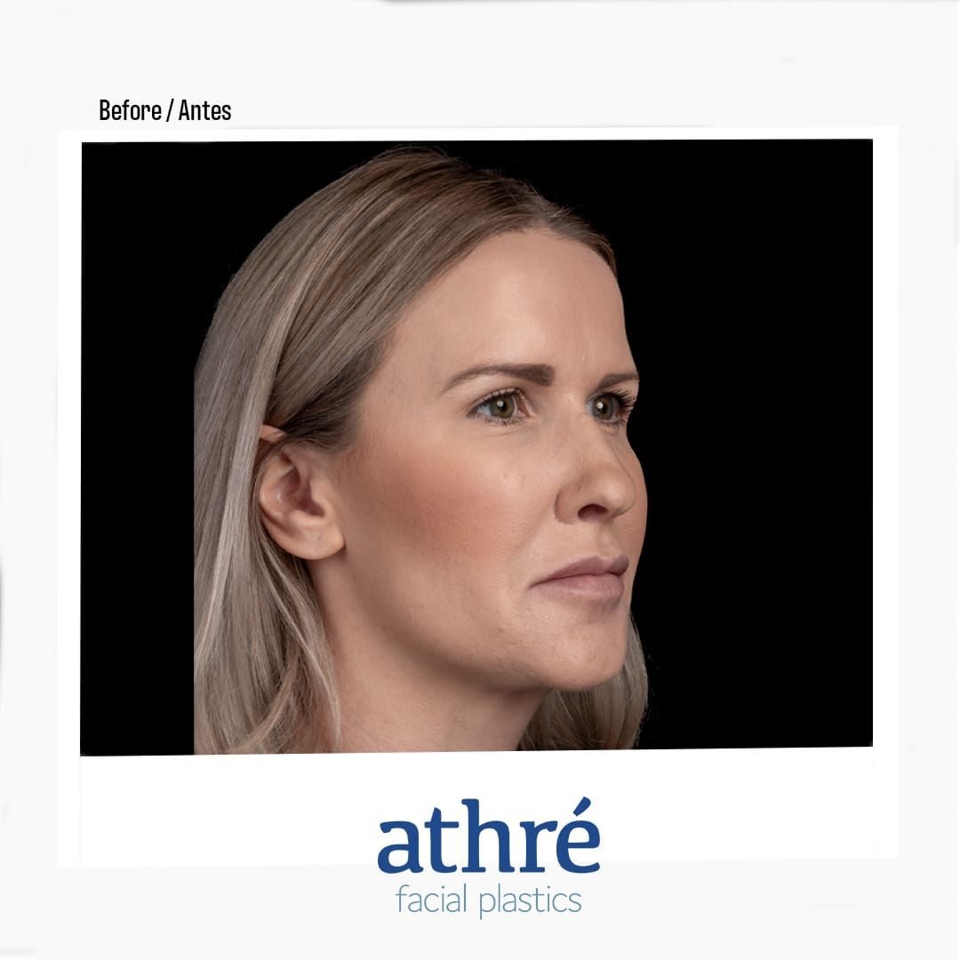 Revision Rhinoplasty Before & After