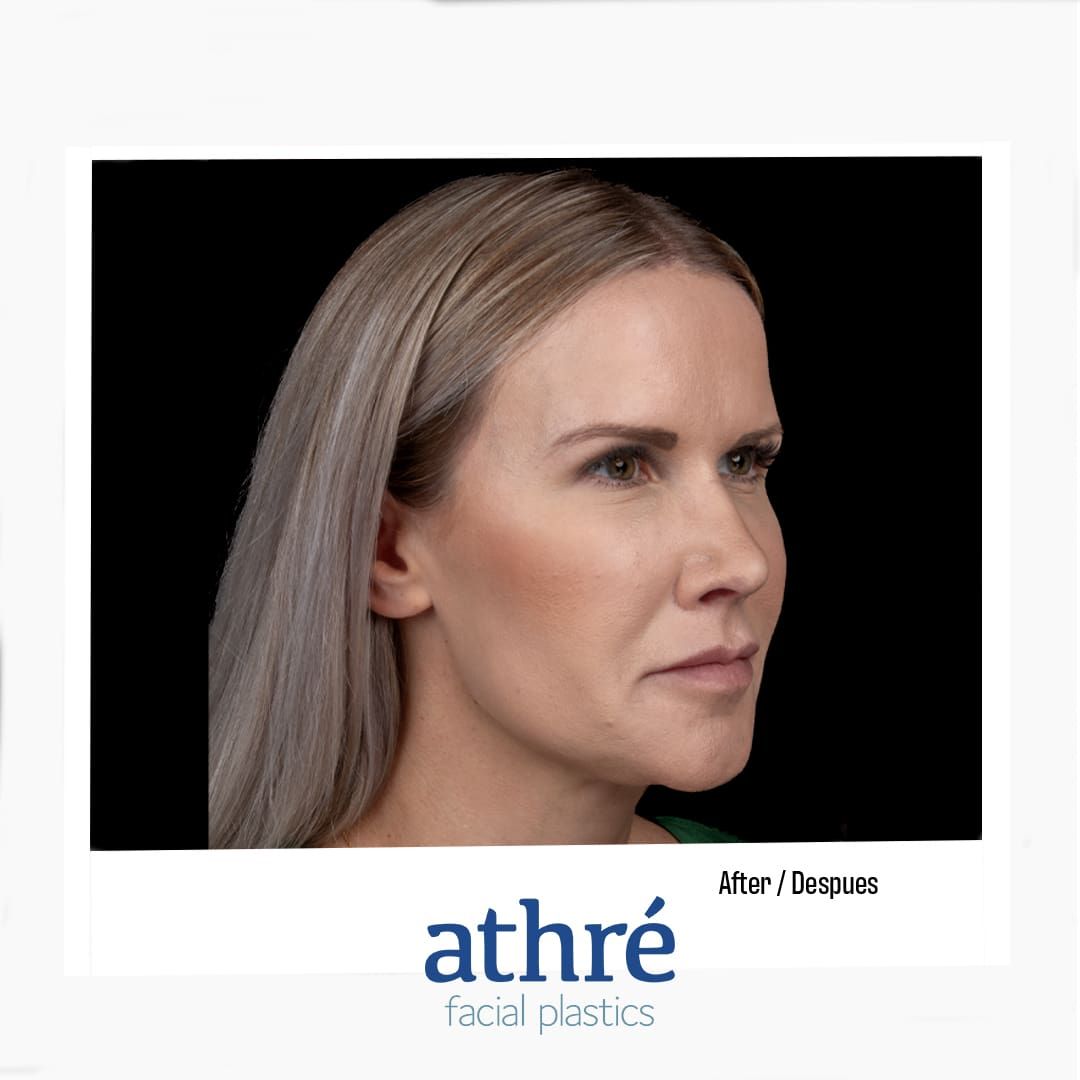 Revision Rhinoplasty Before & After