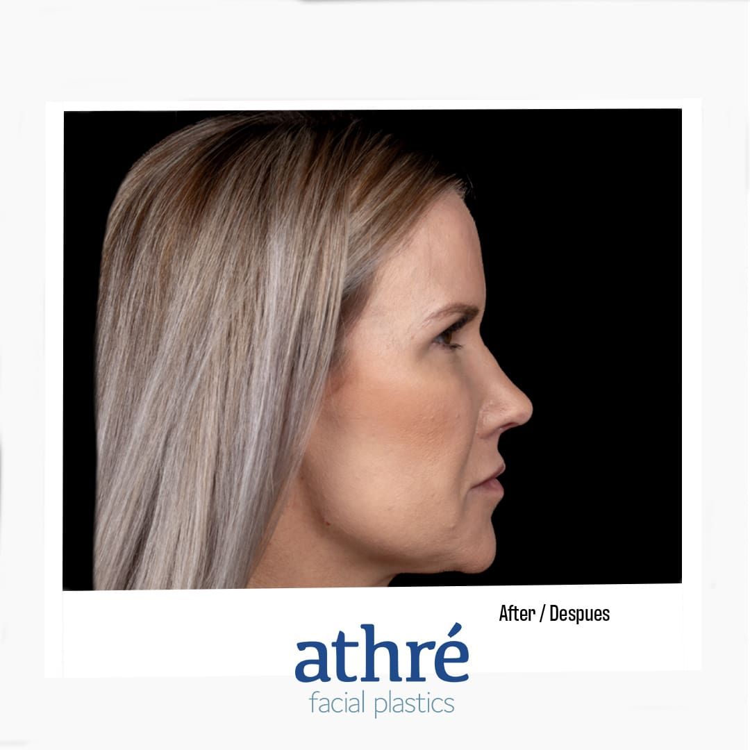 Revision Rhinoplasty Before & After