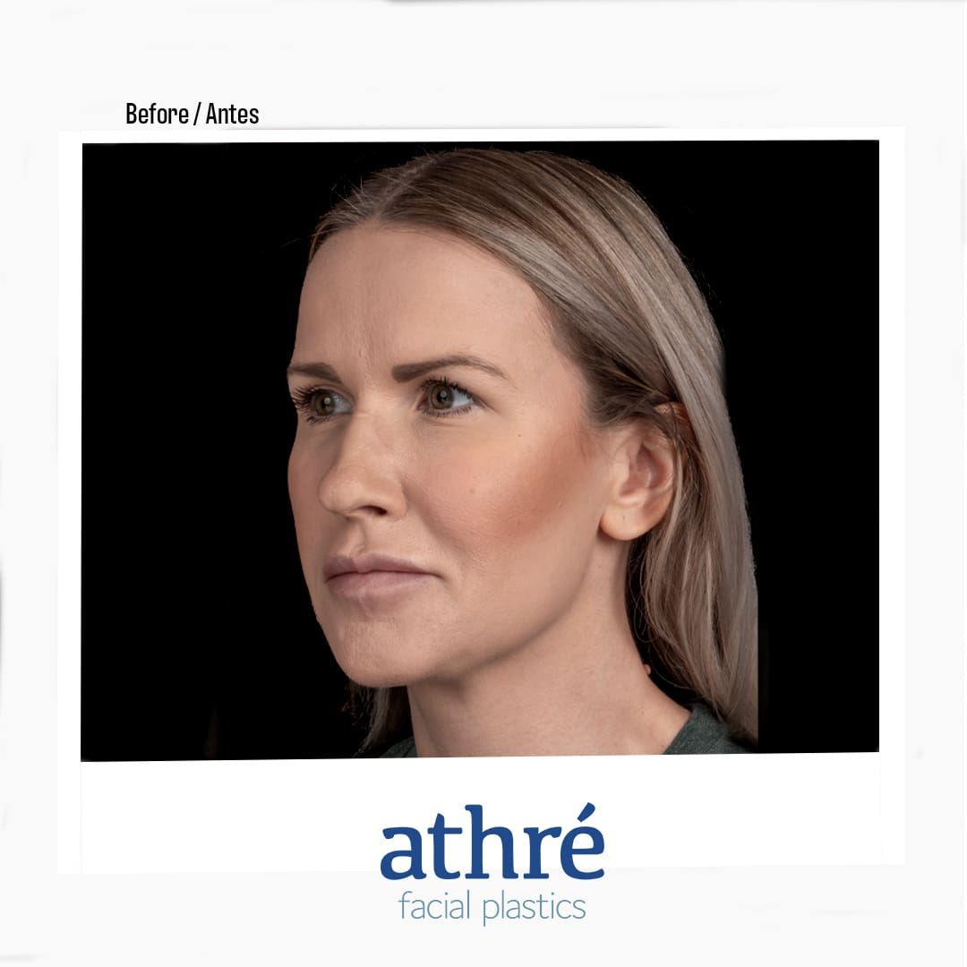 Revision Rhinoplasty Before & After